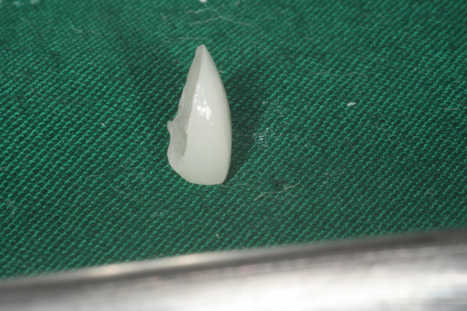 Tania's Dental Projects Ceramic veneers Colour change in luting