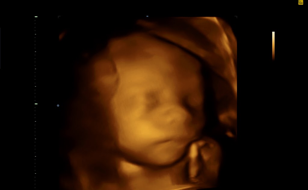 Notre babinou arrive Echographie 3D gratuite à 25 semaines de grossesse