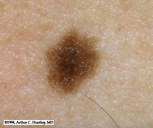 Nevus - Wikipedia