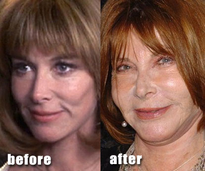 lee-grant-plastic-surgery.jpg