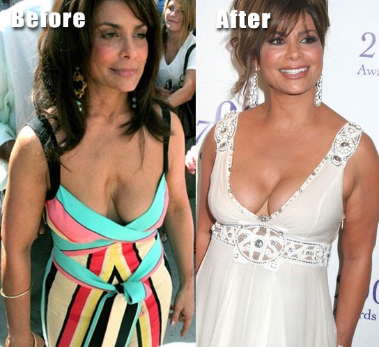 Paula Abdul before and after breast implants? 