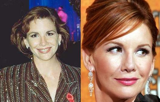 anna faris plastic surgery before after. Melissa Gilbert efore after