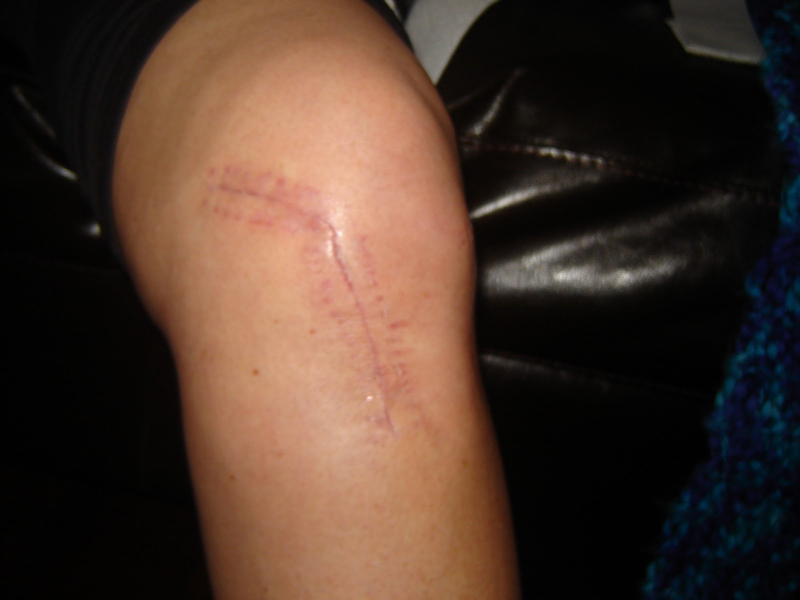 Judy's ACL, PCL, MCL Journey (aka knee dislocation) Day 21 Three Weeks Post Surgery