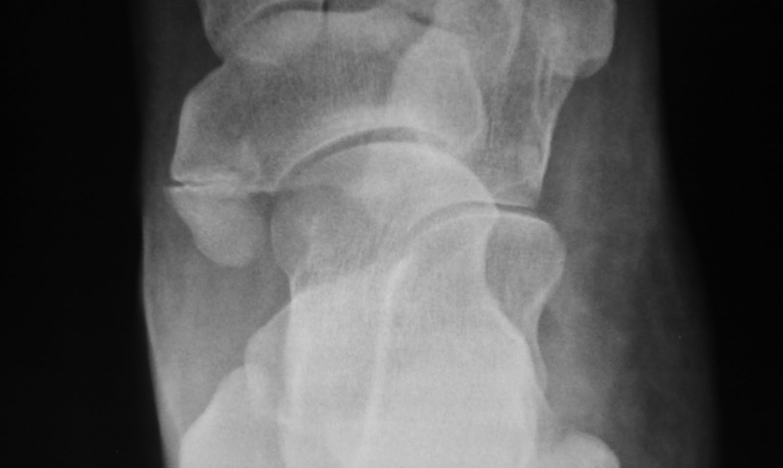 Daily Dose Accessory navicular or fracture?