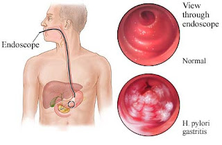 What do I need to know about gastritis