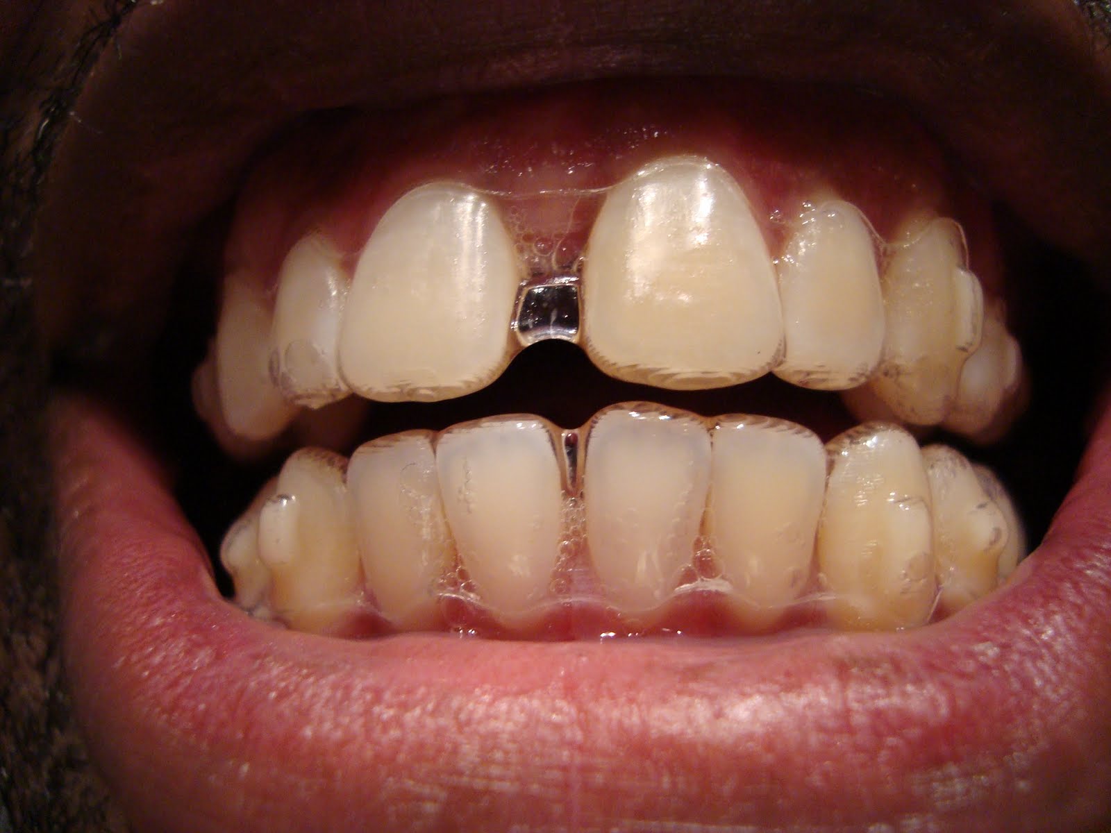 invisalign tray experience
