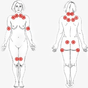 Puntos Hiipersensibles para el diagnóstico de Fibromialgia