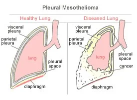 Serene Mesothelioma Vs Lung Pleura Capture Art Serene Mesothelioma Vs Lung Pleura Capture Art