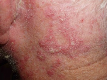 pictures of dermatitis