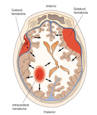 Hematom TREAT WITH THE WHOLE-HEARTED: surgical epidural hematom: 4 clinical ...