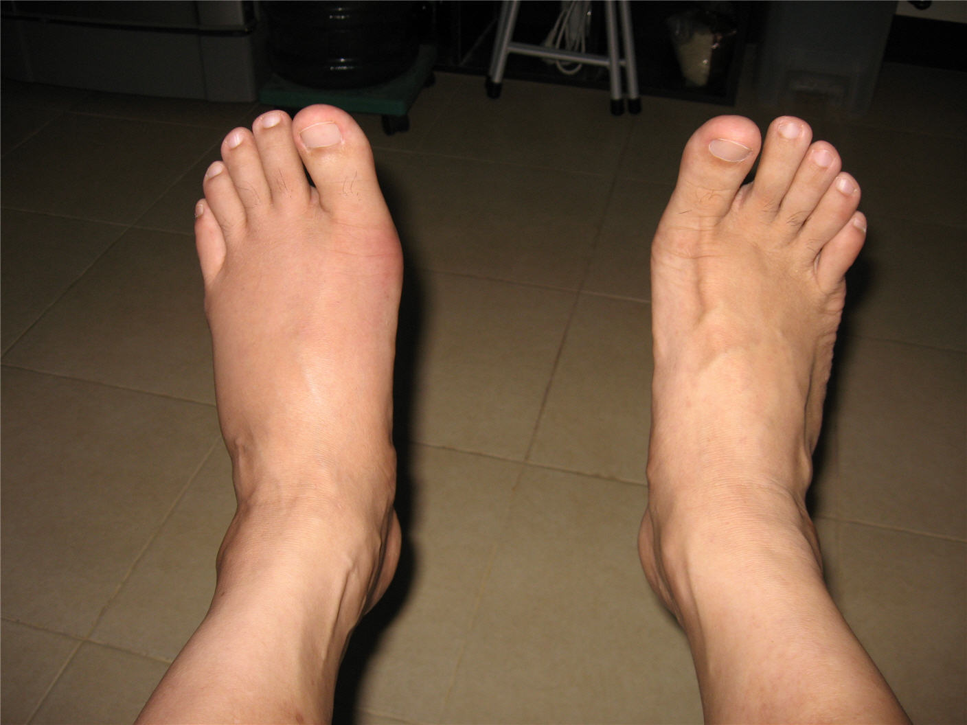 Foot pain home remedies in telugu
