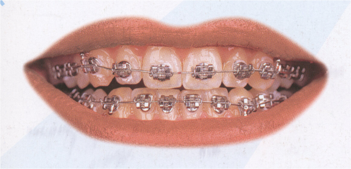 ровные зубы. металлические лигатурные брекеты «пилот». керамические брекеты окрашиваются. сколько стоят брекеты в вологде. металлические брекеты.