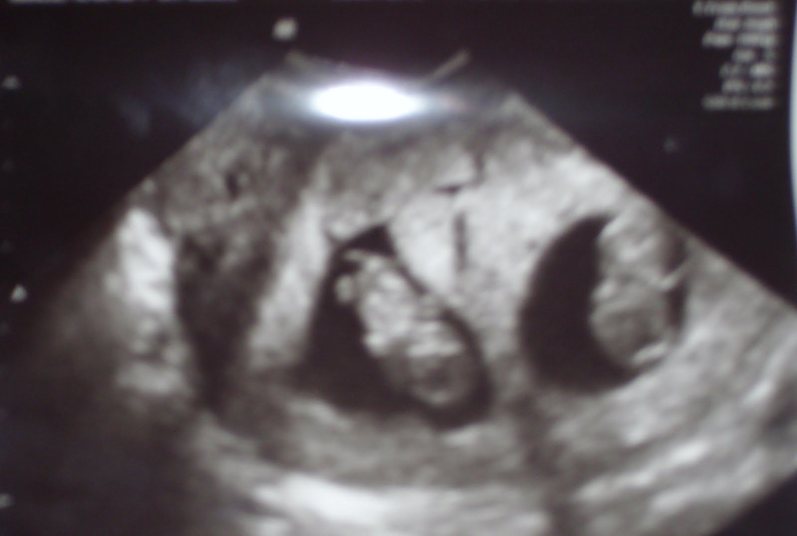 Видео 10 недели. УЗИ 8 недель многоплодная беременность. УЗИ 10 недель беременности двойня. УЗИ 7-8 недель беременности двойня. УЗИ 8 недель беременности двойня.