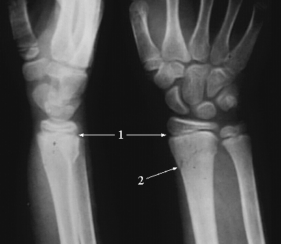 Colles Fracture Plate Jay's Physio: Colle's Fracture
