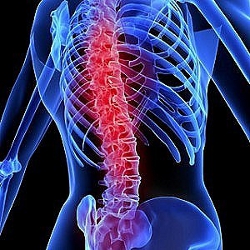 Tratam durerea de spate generata de tasarea vertebrelor (hernie de disc)