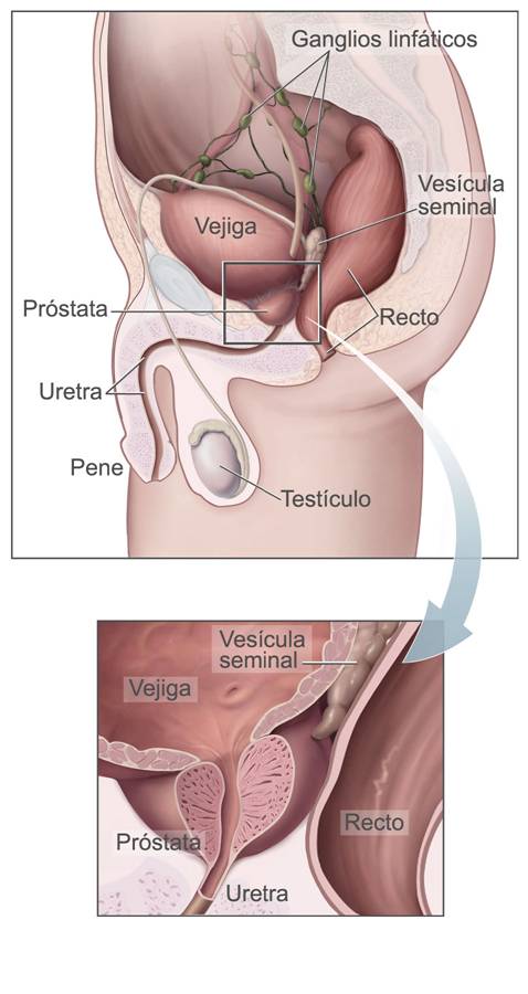 sintomas de prostata obstruida