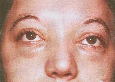 MPH 720 Global Environmental Health Issues: Trichinella spiralis