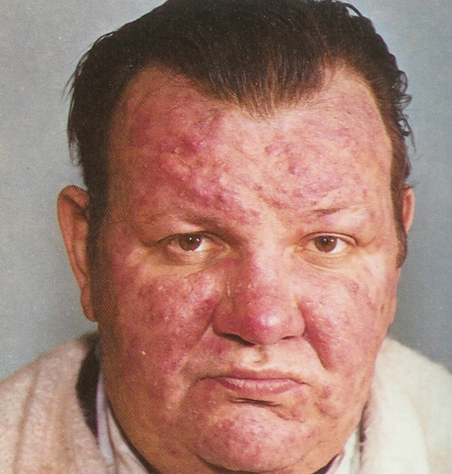 DRA. CYNTHIA FURTADO Acne Rosácea