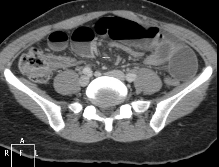 Pain Lower Left Abdomen Pain Lower Left Abdomen Vibration