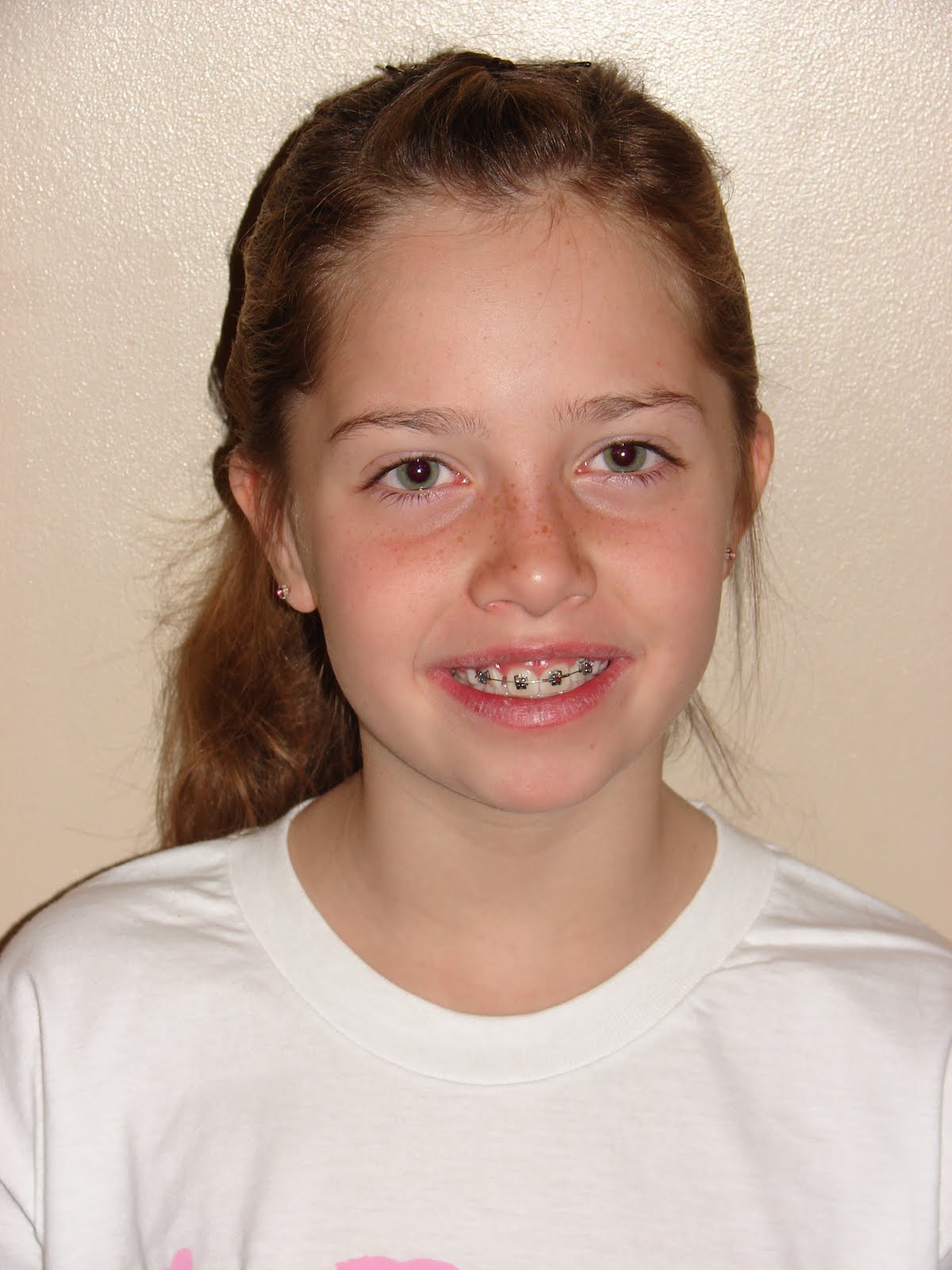 The Graham's Braces and Grades