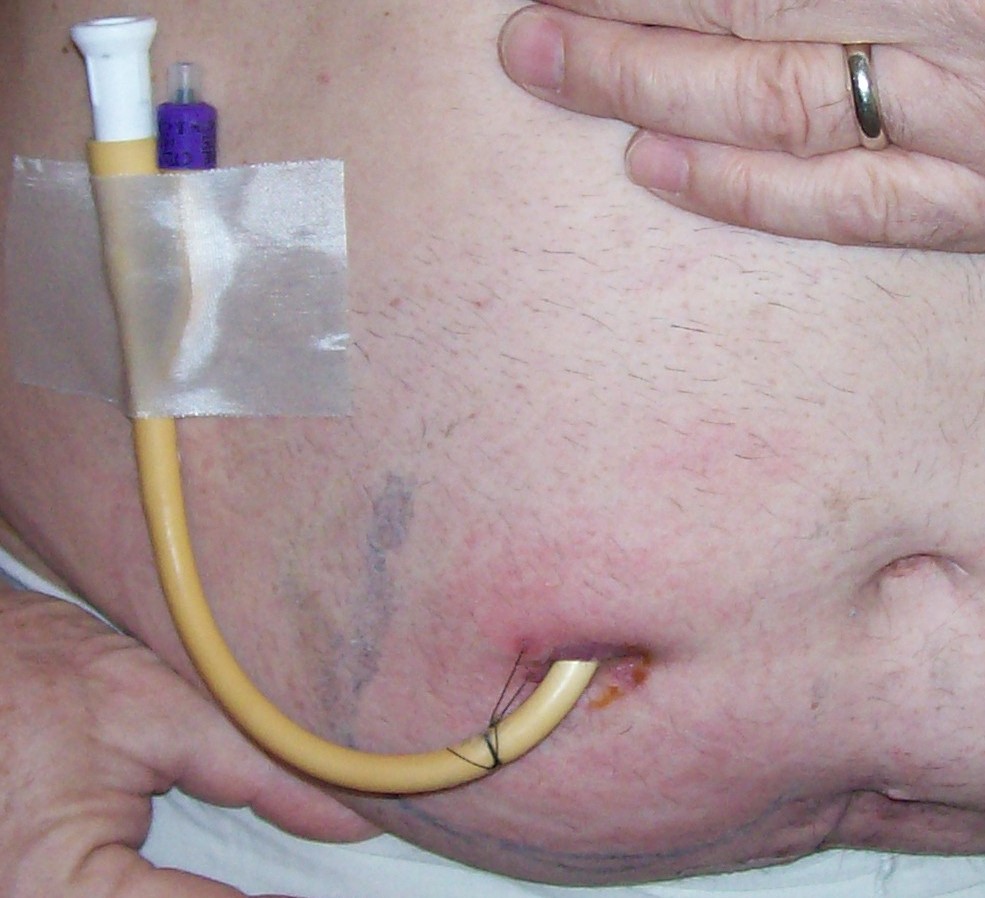 bag bladder removal surgery ostomy cancer catheter suprapubic spc surviving kegel december