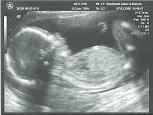 عکس سونوگرافی پاریس در هفته 18 بارداری