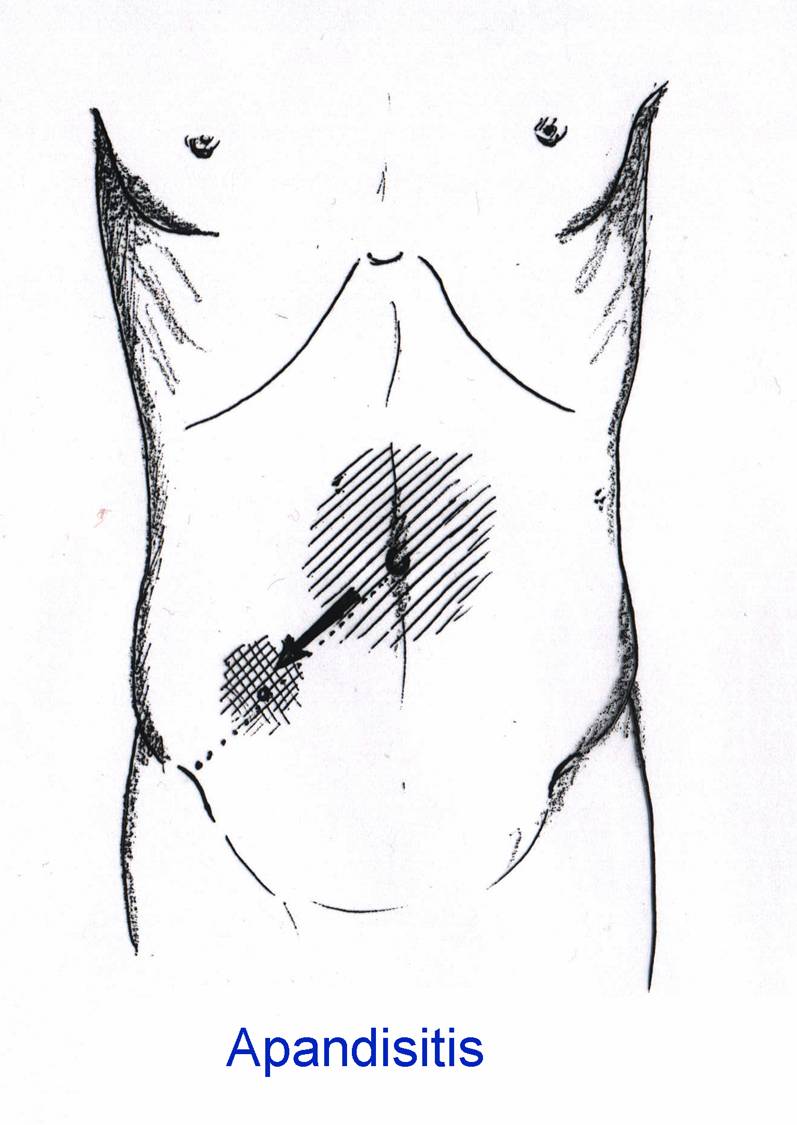 [apandisit-agrisinin-yeri.jpg]