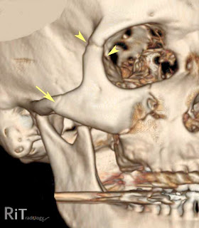 RiT radiology: Zygomaticomaxillary Complex (ZMC) Fracture