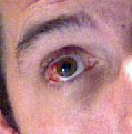 bloodshot eye