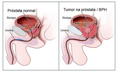 cancer prostata recidiva)