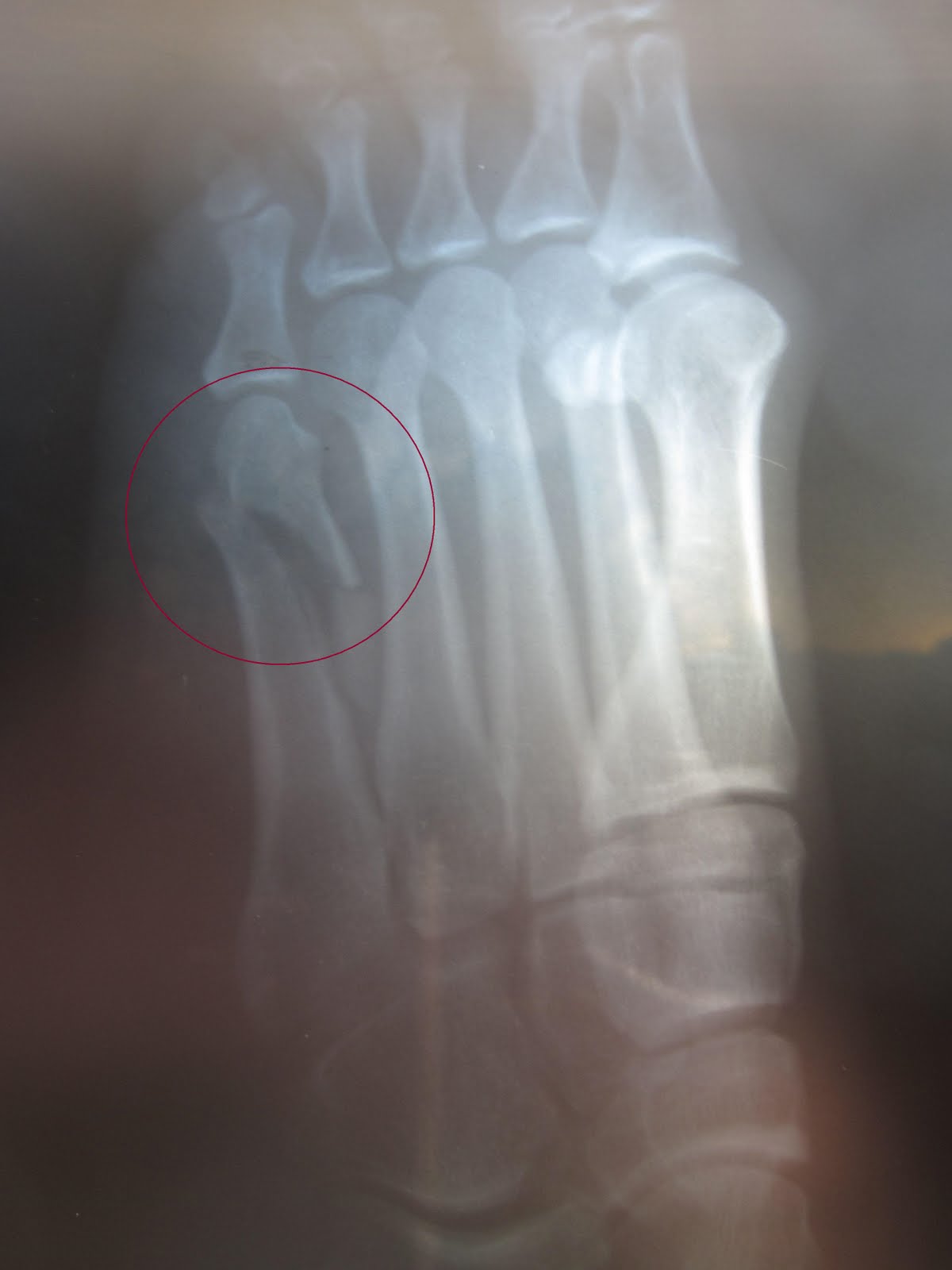 Fifth Metatarsal Fracture Fracture Treatment