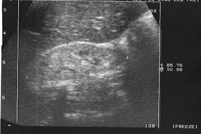 Insuficiencia Renal Cronica ( IRC )