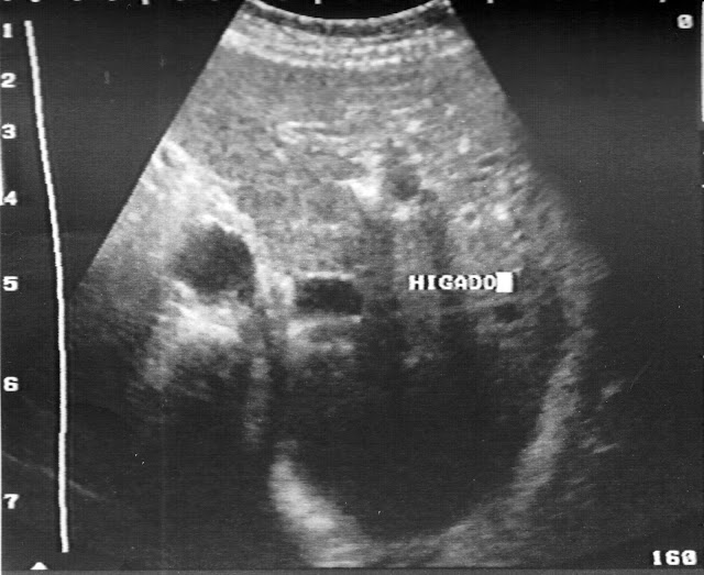 Situs Inversus