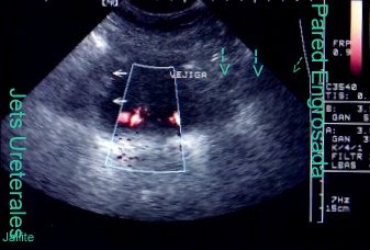 Cistitis Intersticial