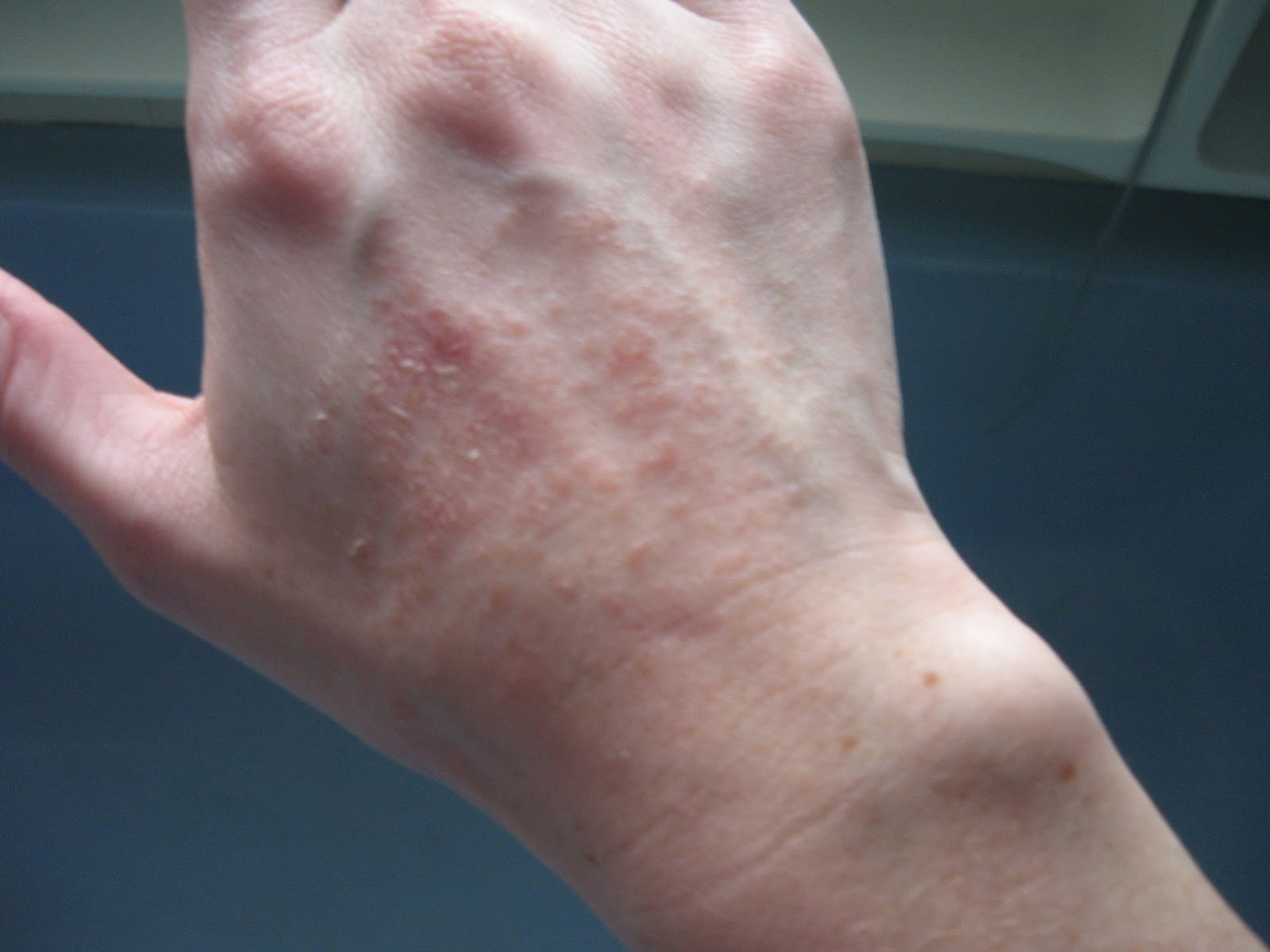 Shingles - Symptoms - WebMD