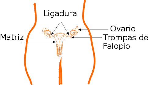 efectos secundarios de la salpingoclasia