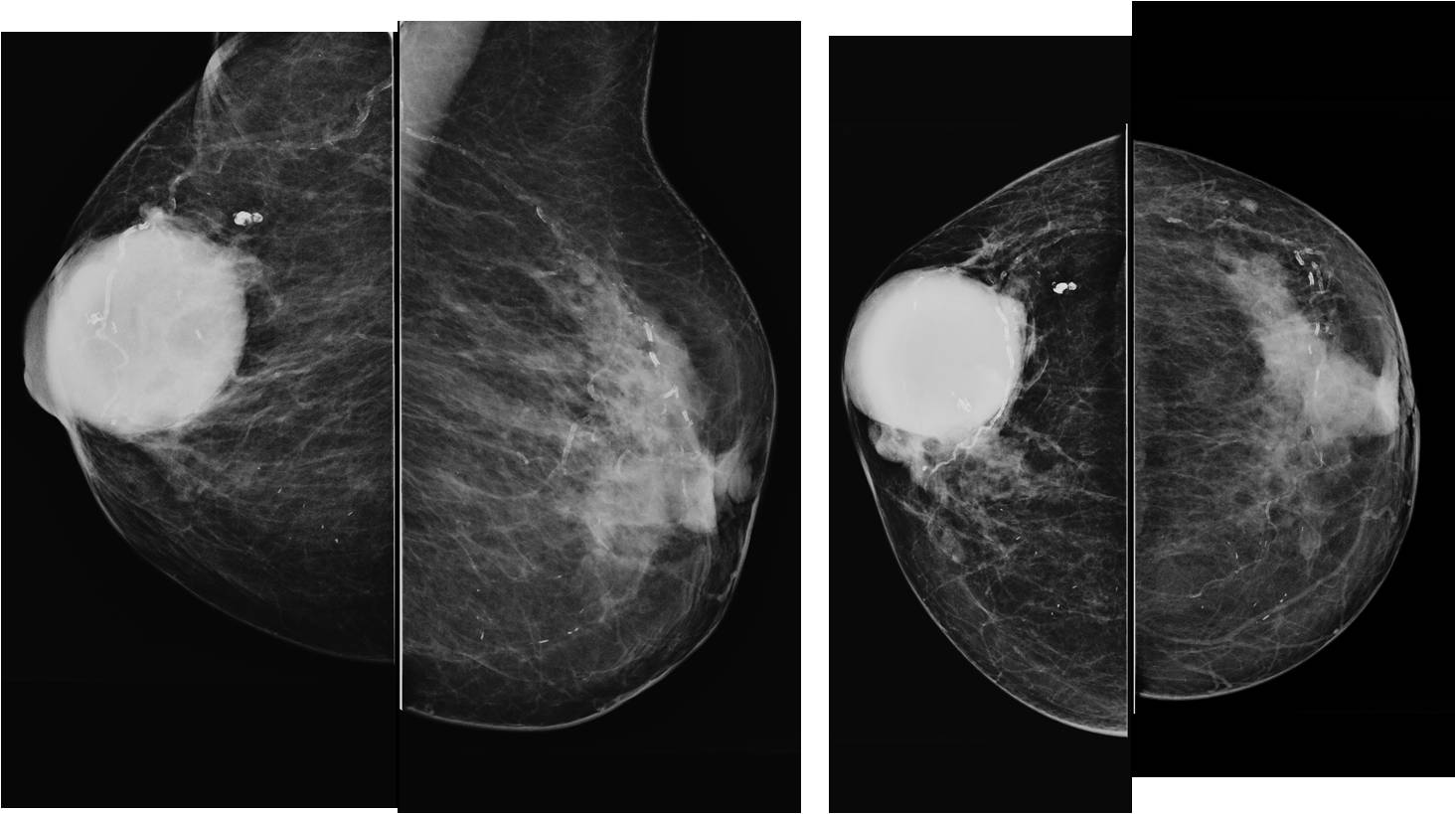 Фиброаденоматоз bi rads 2. Фиброзно кистозная мастопатия BL-rads 2. Бирадс 4с маммография. Категория bi rads 4 маммография. Что такое bi rads 3 на маммографии.