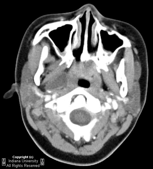 Neuroradiology On the Net Parapharyngeal abscess
