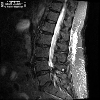 Синдром бострупа в поясничном. Синдром бострупа рентген. Синдром бострупа в поясничном. Синдром baastrup позвонков. Синдром бострупа в поясничном.