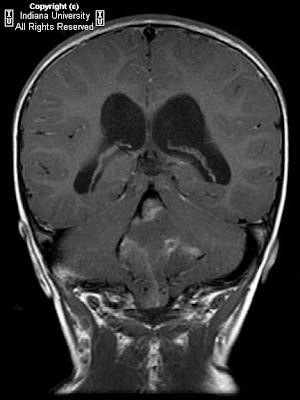 Neuroradiology On the Net: Fourth ventricular ependymoma with foramen