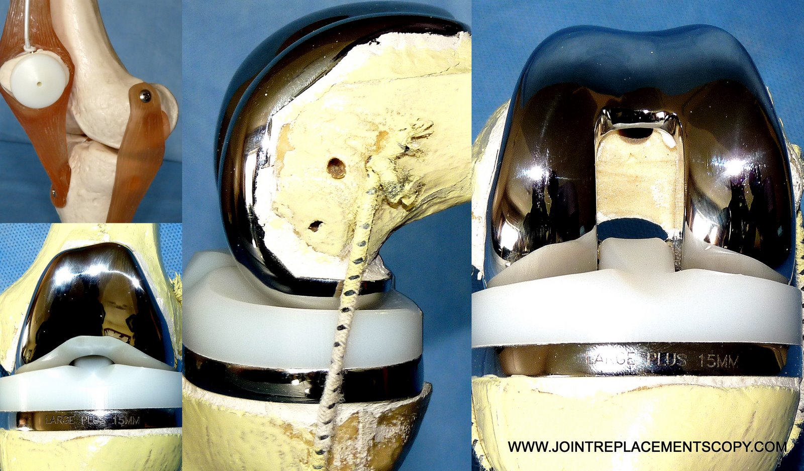 joint care foundation Demo Knee Joint Replacement