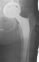 Hip joint x-ray after