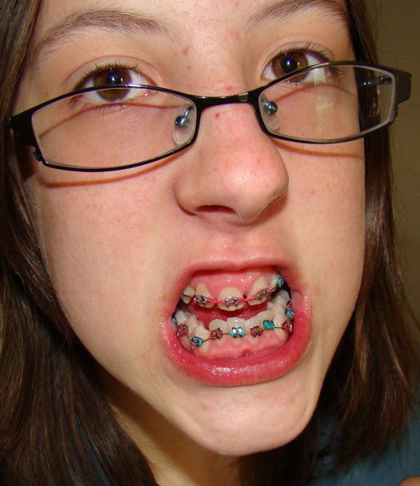 Beans, braces, 'bones