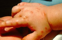 red imported fire ant stings on a young hand