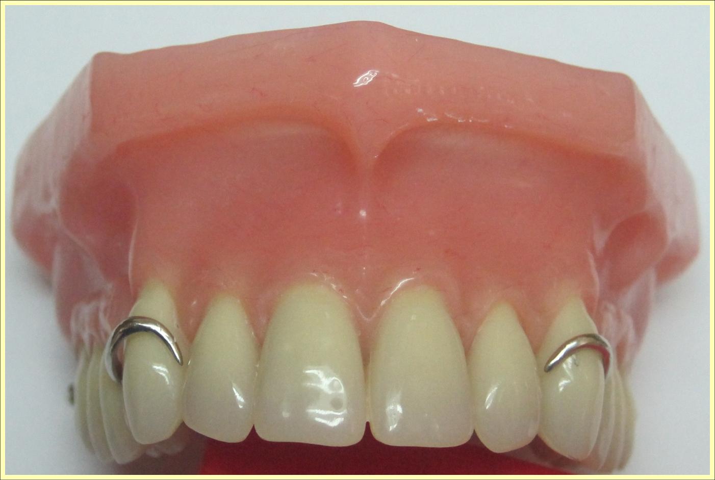 LABORATORIO DENTAL "JMG" PRÓTESIS REMOVIBLE ACRÍLICA