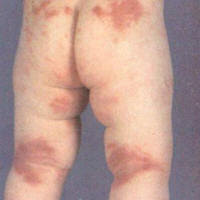 infantile eczema
