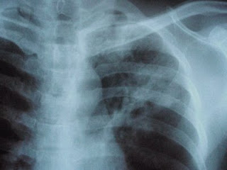 deteriorarea radiografiei articulației încheieturii