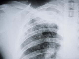 deteriorarea radiografiei articulației încheieturii