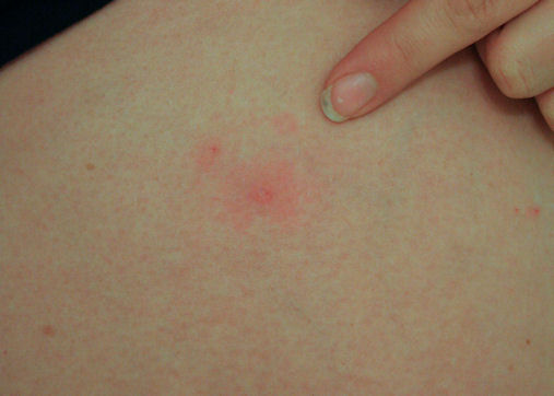 Red Spots on Body, not Itchy, Random, std, Small, Blood ...