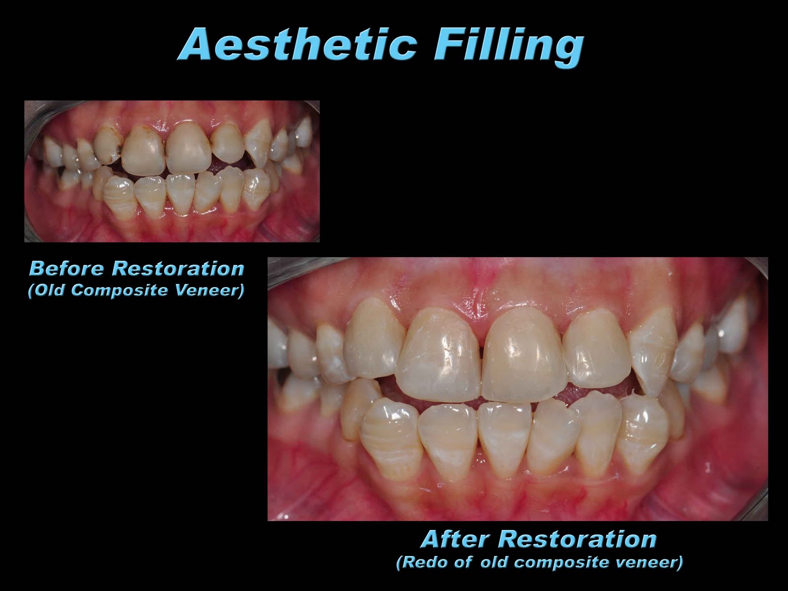 Prestige Dental Care Aesthetic Filling